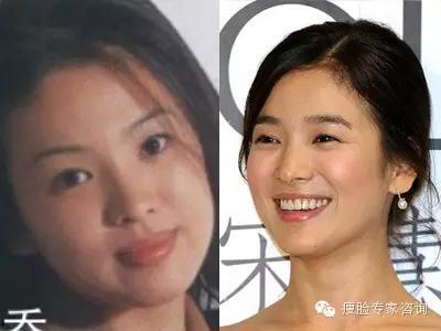 明星整容前后对比照片,揭秘美丽背后的秘密